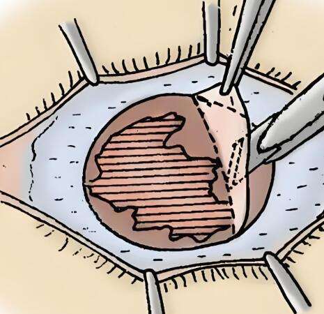 I圓錐角膜移植手術(shù)多少錢？費(fèi)用大約在8000元左右